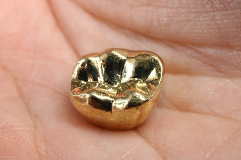 金の入れ歯・金歯は売れる？買取相場から高く売るコツまで徹底解説